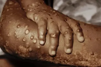 Nigeria : lancement d'une campagne de vaccination contre le Mpox