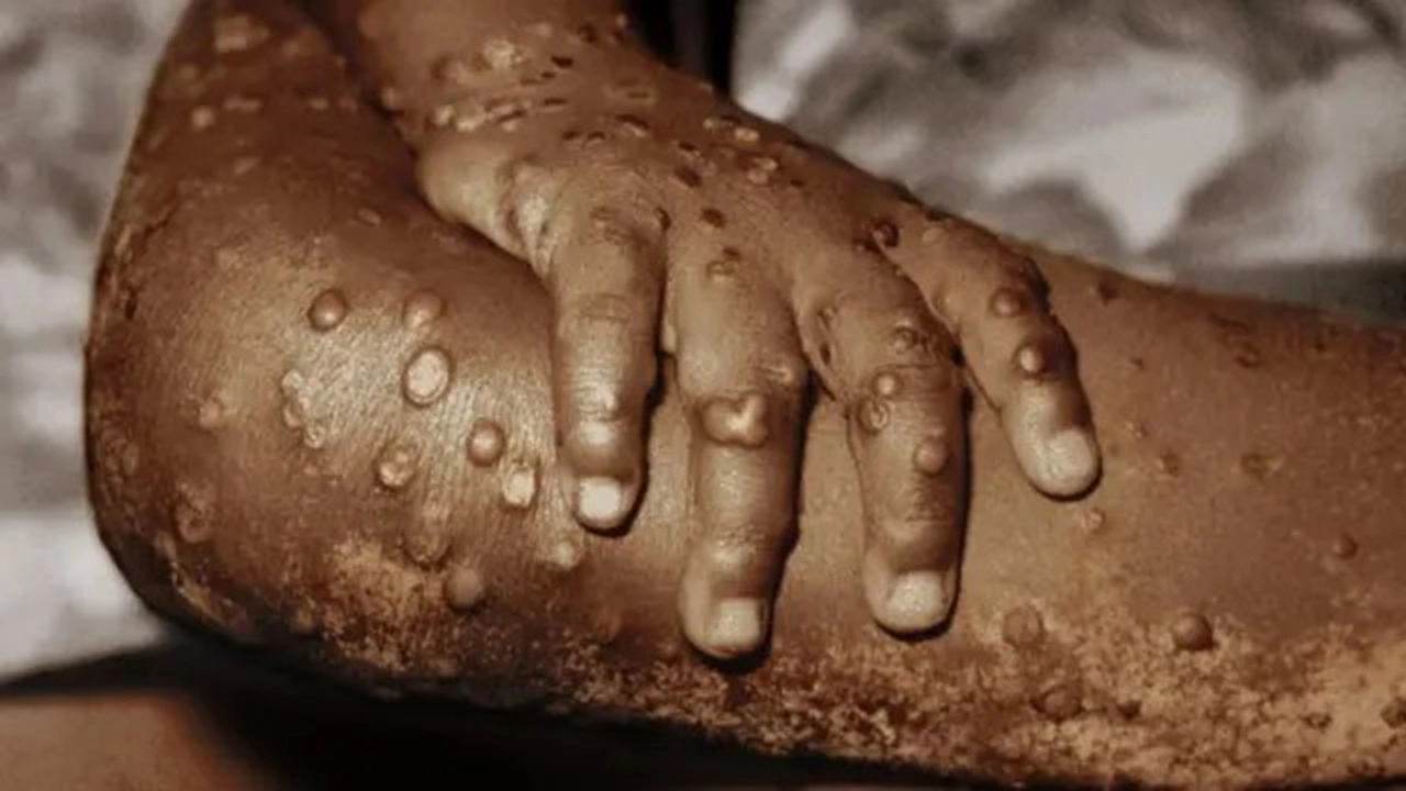 Nigeria : lancement d'une campagne de vaccination contre le Mpox